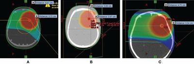 Neutron Radiation Dose Measurements in a Scanning Proton Therapy Room: Can Parents Remain Near Their Children During Treatment?